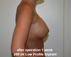 plastic-surgery-breast-augmentation